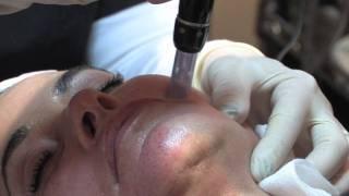 Dermapen Microneedling Training - Certification by Needlelogics