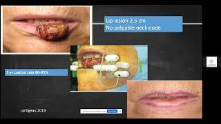 Overview Radiation in Head and Neck Cancer by Dr Suman Mallik