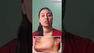 चेहरे पर बाल / Facial hair in PCOS. #shorts #youtubeshorts