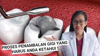 Proses penambalan gigi yang harus Anda ketahui !