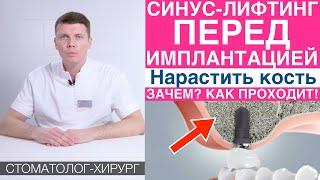 Синус-лифтинг - наращивание костной ткани перед имплантацией зубов. Установка зубных имплантов.