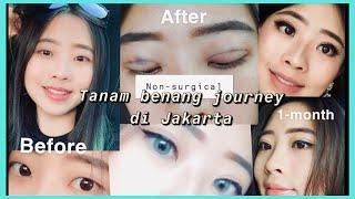 Non-incisional double eyelid stitching (PENGALAMAN & REVIEW TANAM BENANG DI JAKARTA) - CannyGouw