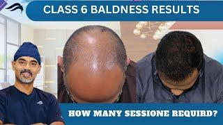 Hair Transplant In Chennai | Best Surgeon Cost Clinic & Results Of Hair Transplant Of Chennai