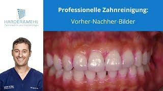 Professionelle Zahnreinigung: Vorher-Nachher-Bilder