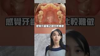 隱形牙套做拔牙矯正可行嗎？隱適美#隱形牙套