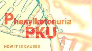 Phenylketonuria | PKU | Mental Retardation | Phenylalanine Hydroxylase