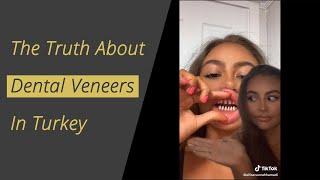 The Truth about Dental Veneers in Turkey