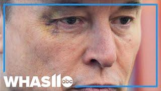 Elon Musk appears at White House with black eye; announces departure