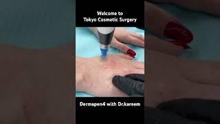 Dermapen4 with Dr.kareem at Tokyo cosmetic surgery in Dubai