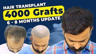 Best Hair Transplant Clinic In Bhopal|| Hair Transplant Patient Review || Cost of Hair Transplant