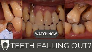 All-on-4 Dental Implants | Dr Ope's Detailed Case Discussion