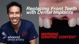 Replacing missing front teeth with dental implants - Charlene