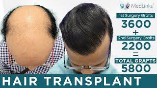 Best Hair Transplant Results in Delhi, India | Best Hair Transplant Clinic in Delhi | Medlinks