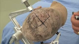 Skull Clamp Placement: Parietal Craniotomy-Incision (Preview)