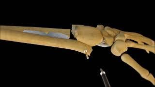 3d bone repair device procedure Austin Visuals orthopedic - Austin Visuals 3D Animation Studio