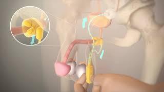 Post Prostatectomy (Part 07): The Artificial Sphincter