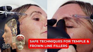 Mastering Temple and Frown Line Fillers: Safe Techniques for Resistant Cases