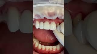 Импланты коронки из диоксида циркония