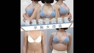 魔滴複合式隆乳 ▏平胸大改造，打造自然美胸！#尚凌診所