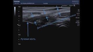 Передний косой скан для визуализации дистального сухожилия бицепса плеча