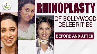 Rhinoplasty of Bollywood Celebrities Before And After | Bollywood Actress Who Did Plastic Surgery?