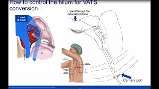 Dr. Blackmon  VATS Intraoperative Events: 2015