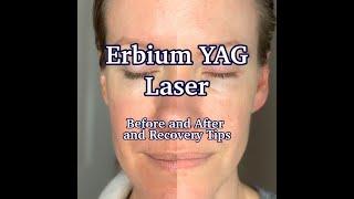 Erbium YAG Laser Treatment | Results and Post-Care