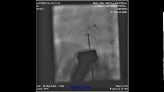 Baby Shagota 17 M 10 Kg Large ASD II Device closure done by 14 mm cera device