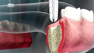 Zahn-Implantate - nicht für jeden geeignet