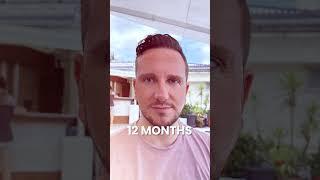 12 months after George’s hair transplant - Evaluation by Dr. Mehmet Erdoğan