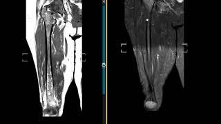 Waldenstrom macroglobulinemia on MRI