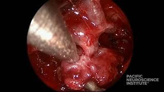 Endoscopic Endonasal Meningioma Surgery