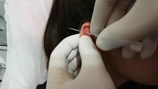 Kıkırdak  ( Helix ) Piercing Delimi