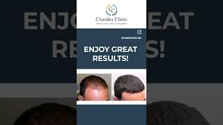 Growth Factor Concentrate Therapy Result | GFC Therapy in Delhi|Best Hair Transplant Clinic in Delhi