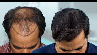 Best Hair Transplant  Experience in Bikaner I Amazing Hair Transplant cost & Result in Bikaner #dhi