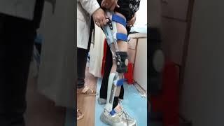 Knee Ankle Foot Orthosis/ Polio Caliper.