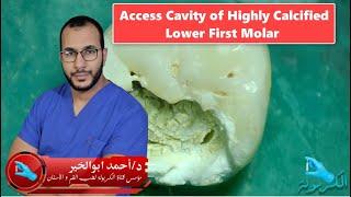 Access Cavity Demo on Highly Calcified Lower First Molar (ep 12)