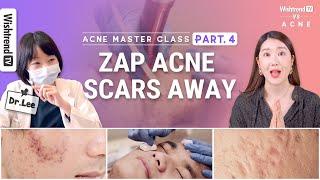 Acne Scar Treatment in Korea: Fraxel Lasers, Microneedling & Home Care TipsㅣPart4