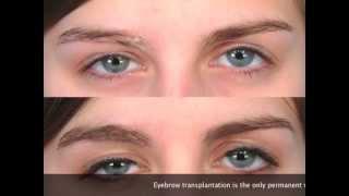 Eyebrow Transplant in Florida - Dr. Alan Bauman