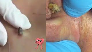 Ultimate Pimple Popping Extravaganza 2024! 