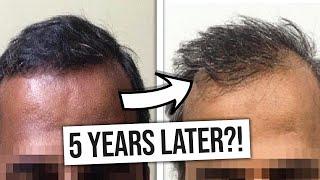 Hair Transplants: Do They Last Forever? - The Truth