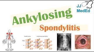 Ankylosing Spondylitis | HLA-B27, Pathophysiology, Signs & Symptoms, Diagnosis, Treatment