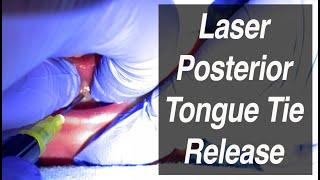 Laser Posterior Tongue Tie Release