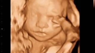 3D Sono Image | 3D Pregnancy Ultrasound