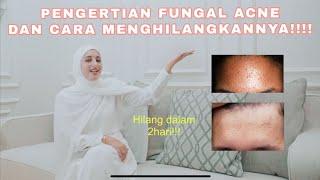 MENGENAL FUNGAL ACNE DAN CARA MENYEMBUHKANNYA!!!!!!