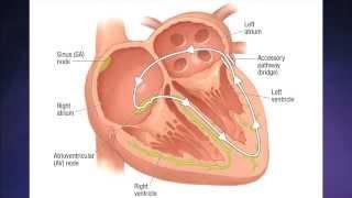 Supraventricular Tachycardia