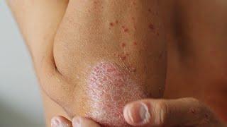 What Is Plaque Psoriasis?