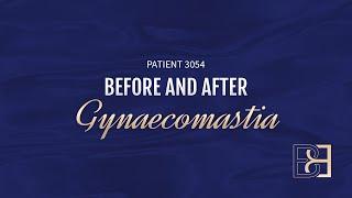 Gynaecomastia with VASER Liposuction {Patient 3054} Before & After