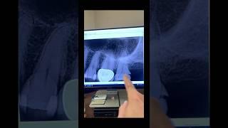 Root canal therapy of tooth #15. #endodontist #dentist #rootcanal #dentistry #dentalassistant #teeth