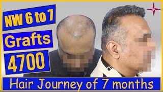 Hair Transplantation Result in 7 Months, 4700 Grafts, Grade 6 @Eugenix  by Drs Sethi & Bansal